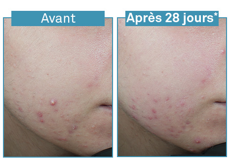 Results Luxéol Sérum Anti-Imperfeições